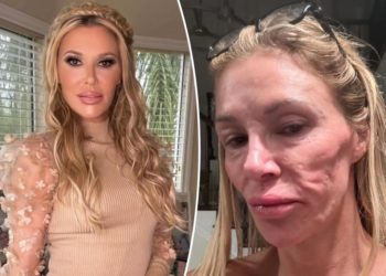 Brandi Glanville reveals whopping 6-figure medical costs to treat mystery facial parasite: ‘I’m out of funds’