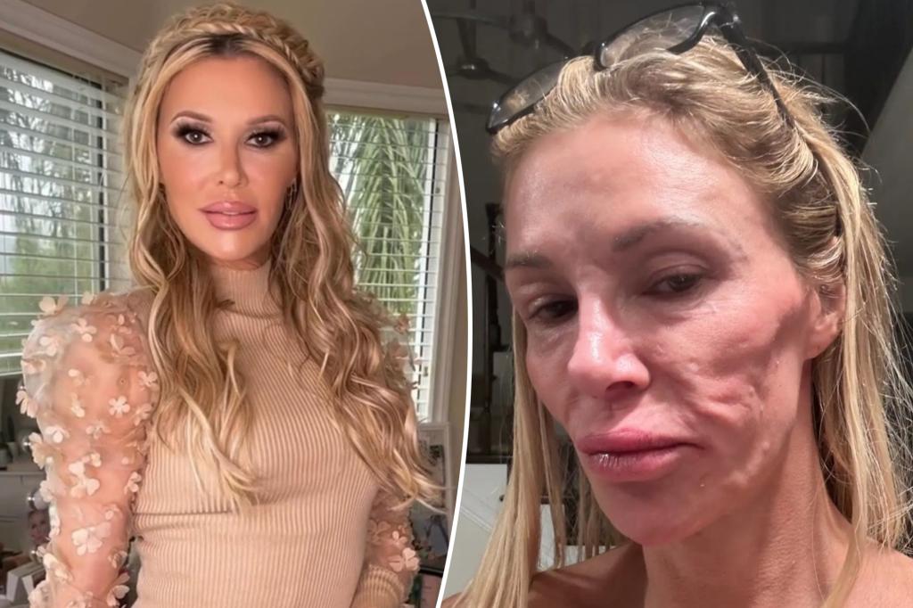 Brandi Glanville reveals whopping 6-figure medical costs to treat mystery facial parasite: ‘I’m out of funds’