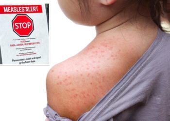 Massive Measles outbreak shows now signs of slowing down as cases explode across the US
