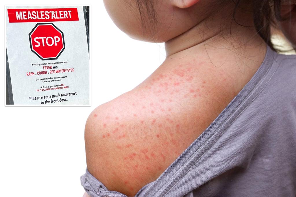 Massive Measles outbreak shows now signs of slowing down as cases explode across the US