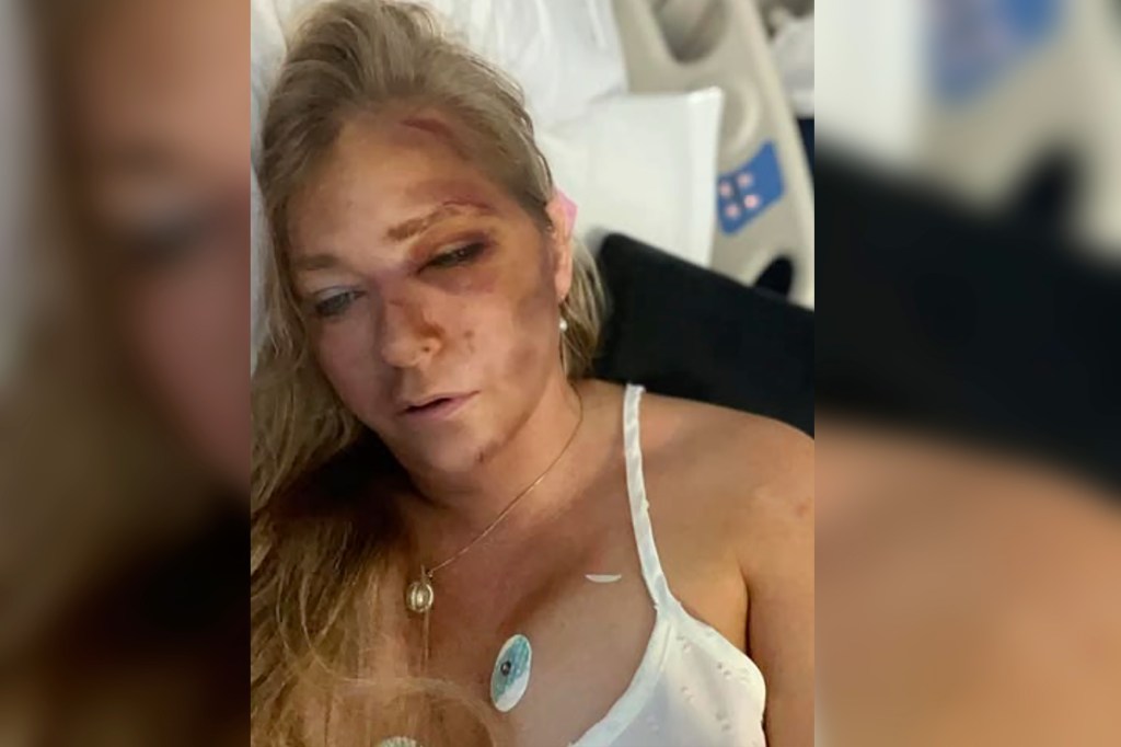 Virginia Giuffre in the hospital with face injuries. 