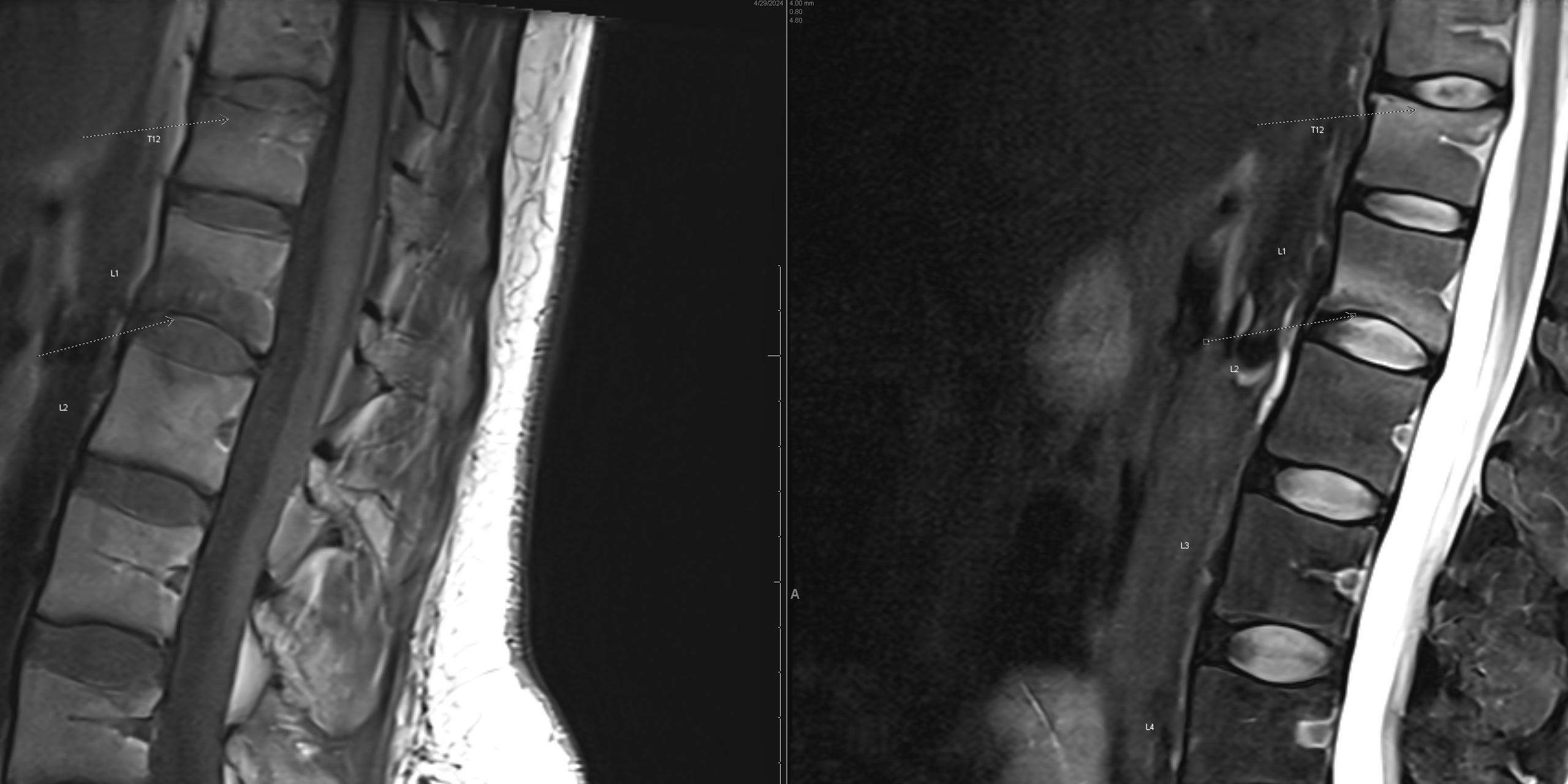 An x-ray image of an osteoporosis compression fracture