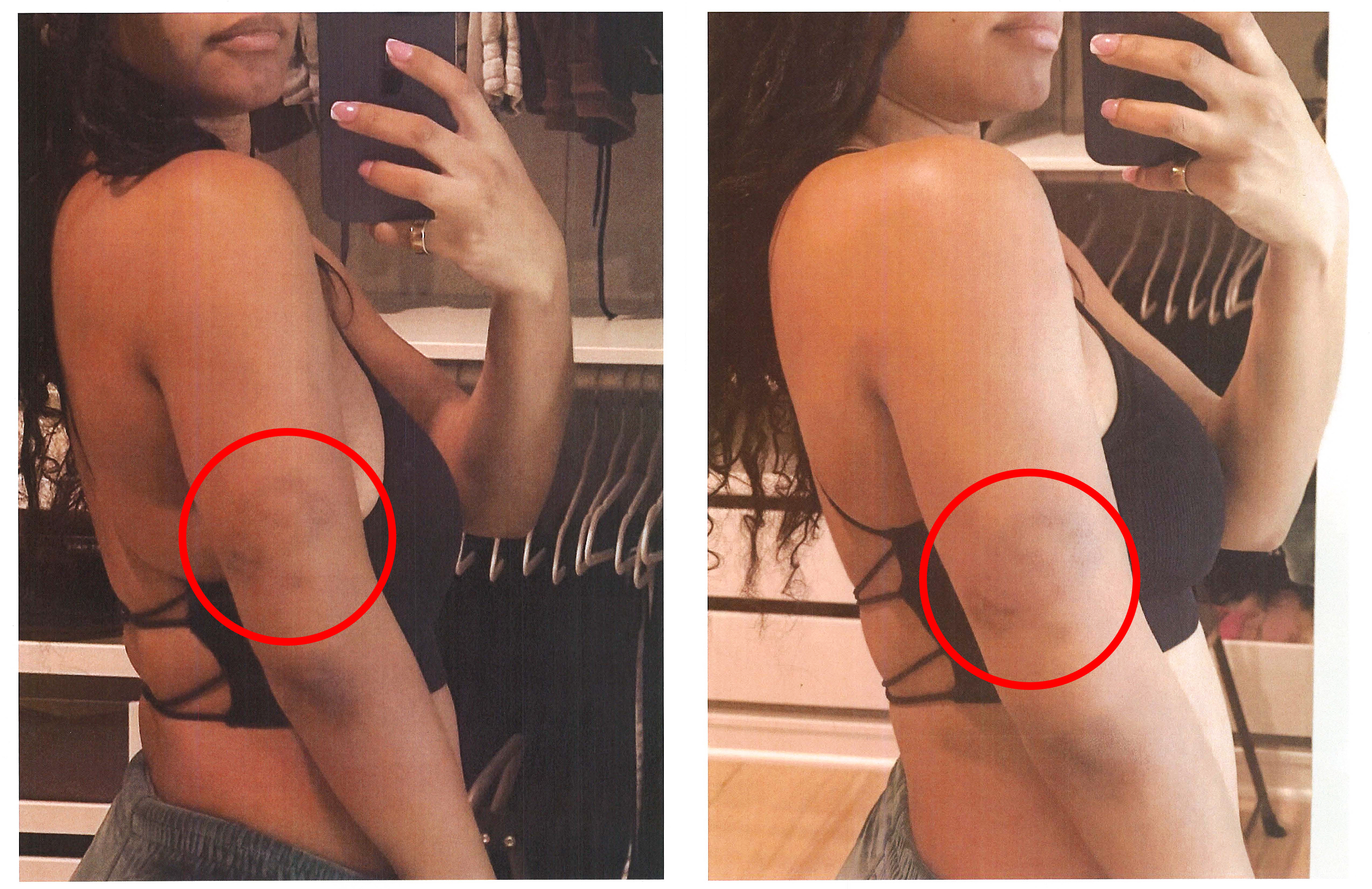 Halle Bailey's bruised arms in court document photos. 