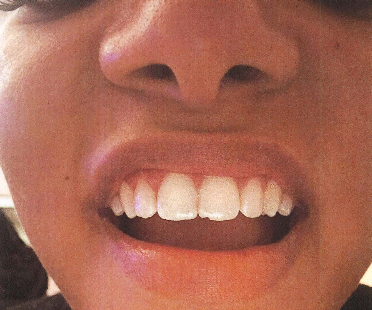 Halle Bailey's chipped tooth. 