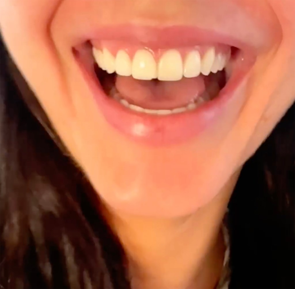 Kendall Jenner after she chipped her front tooth in a video posted by Kylie Jenner Tuesday. 