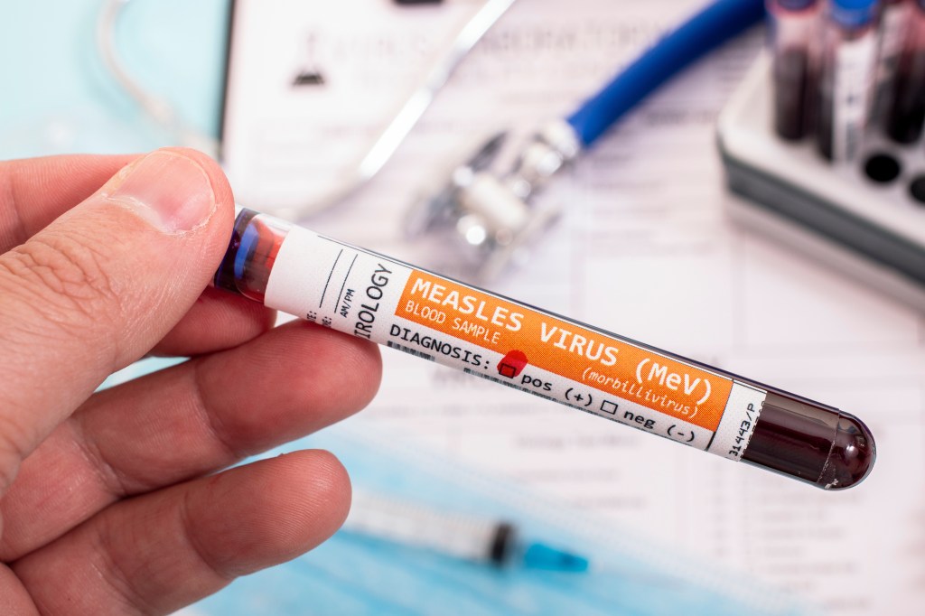 Fictional Blood samples with infected measles virus