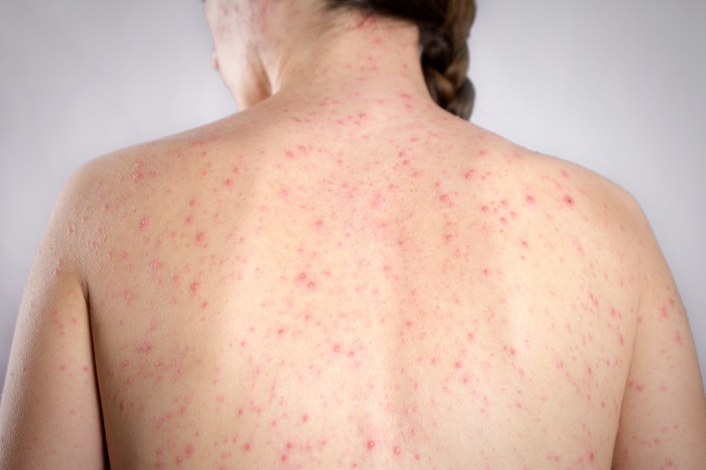 Girls back skin bubble rash