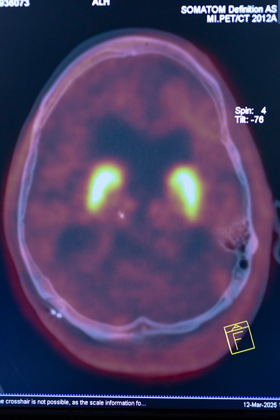 image of brain scan with brain outlined in purple and two regions glowing bright yellow alongside printed notes