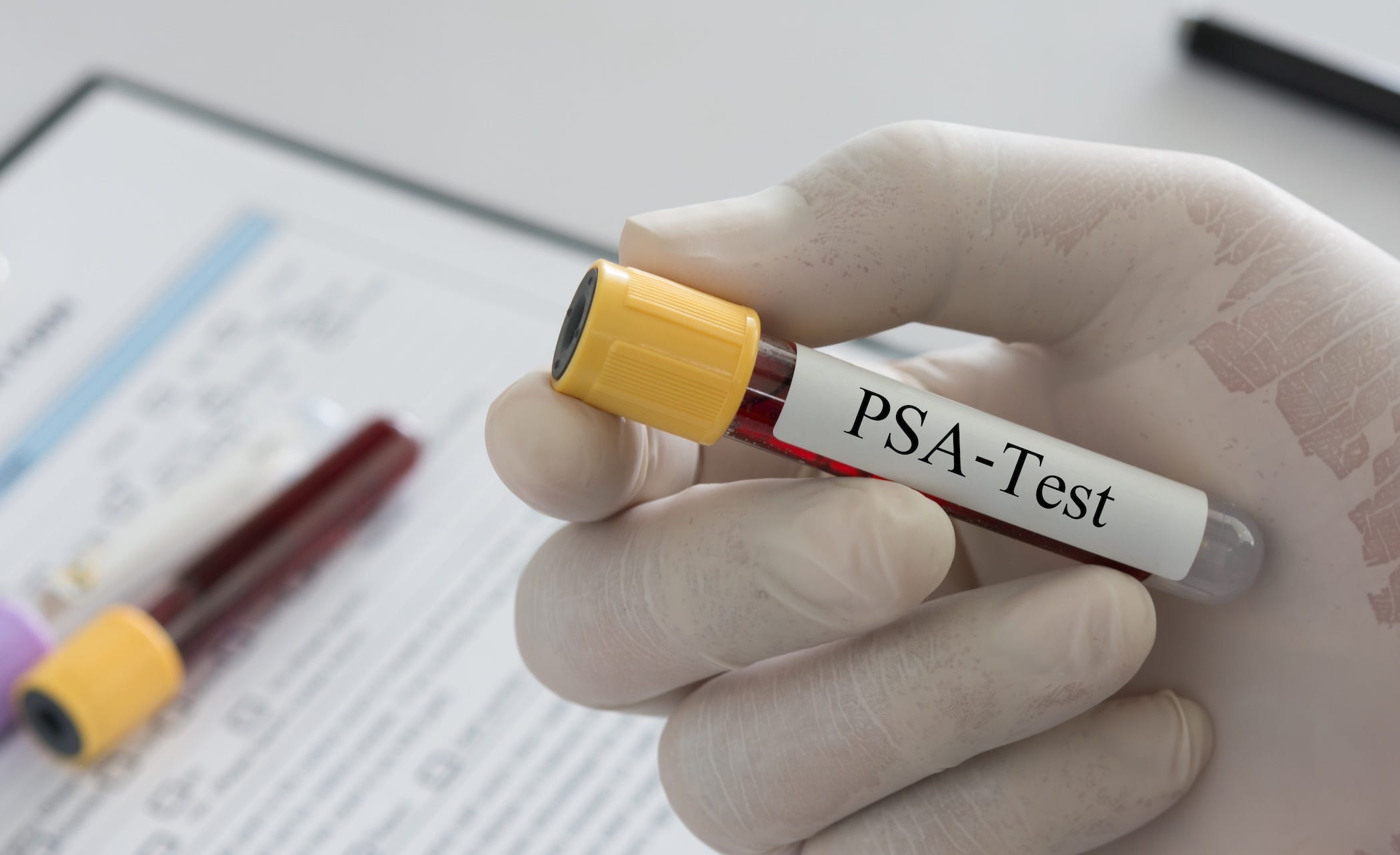 psa blood test for prostate cancer