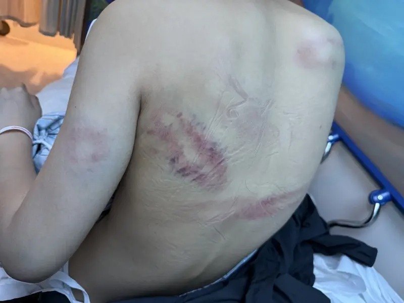 Photo of girl's back bruised as she sits on hospital gurney