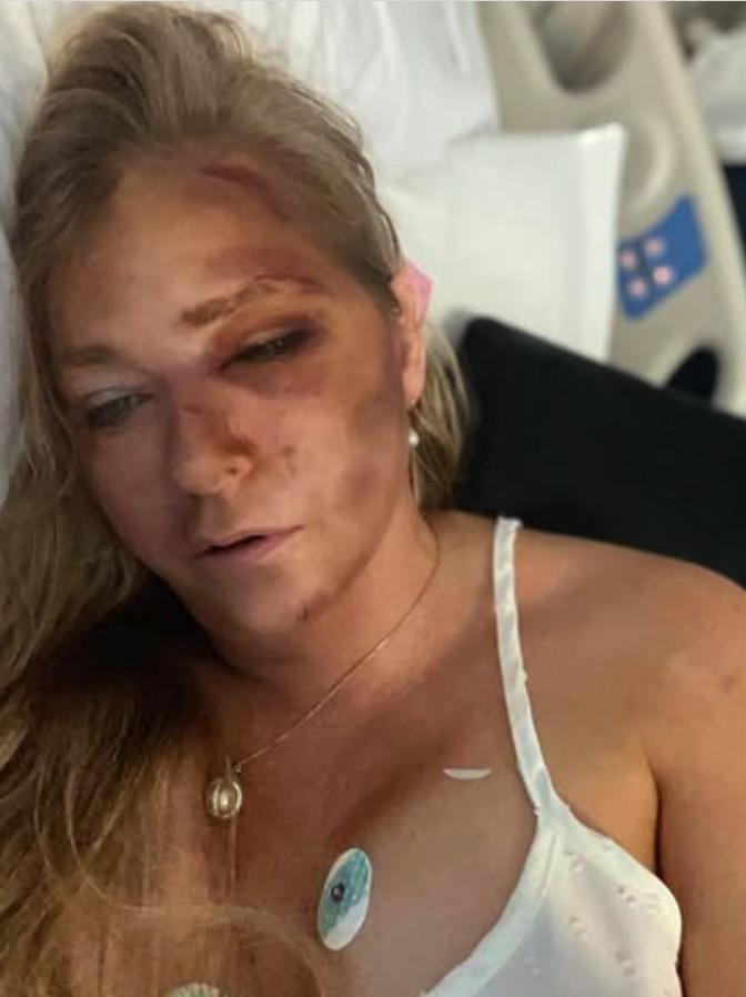 Virginia Giuffren with a bruised face