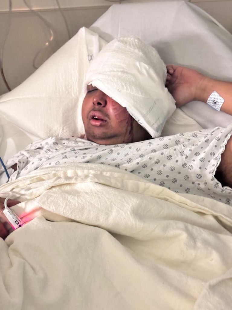 The off-duty cop suffered multiple facial fractures in the assault. 
