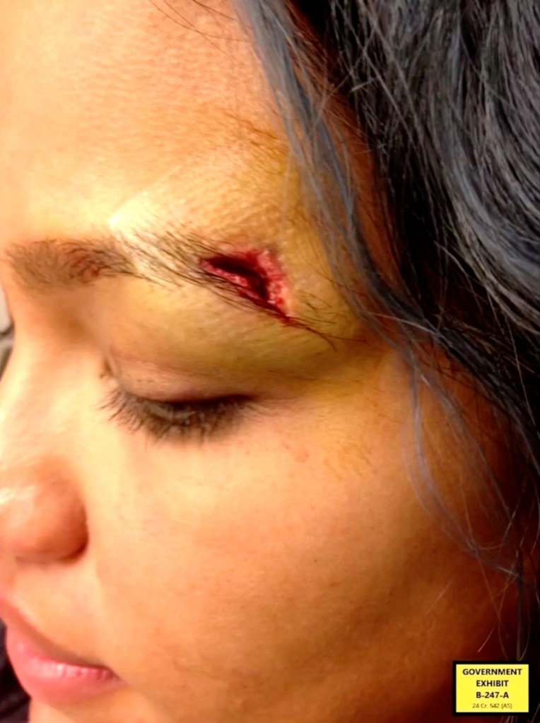 Cassie Ventura injuries