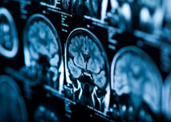 Dementia cases are skyrocketing in China and no one knows why