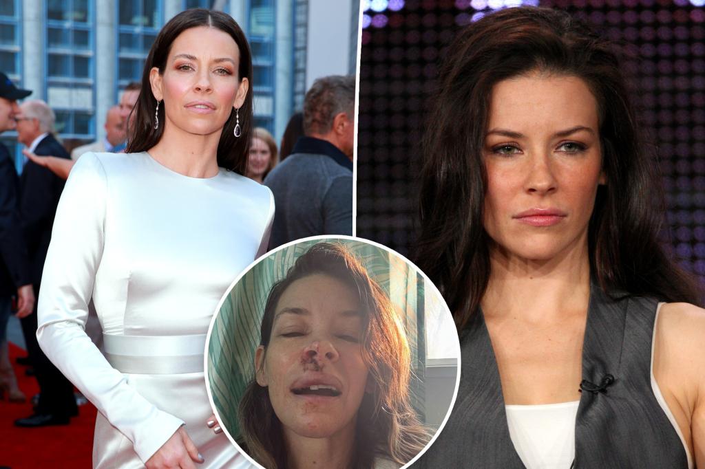 Evangeline Lilly shows off gruesome face injuries after fainting on the beach
