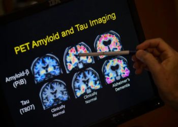 FDA approves blood test that can help diagnose Alzheimer’s disease