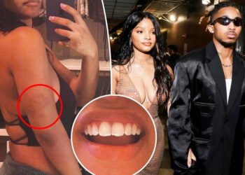Halle Bailey claims ex DDG viciously attacked her multiple times, shares photos of bruises and chipped tooth