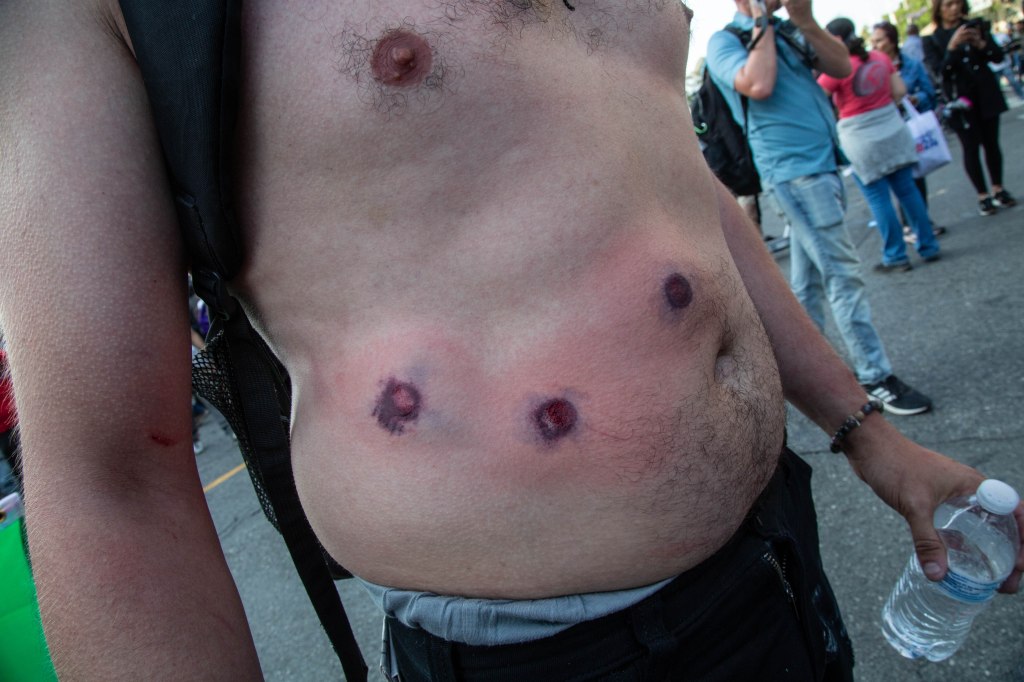A person's torso showing wounds from rubber bullets.