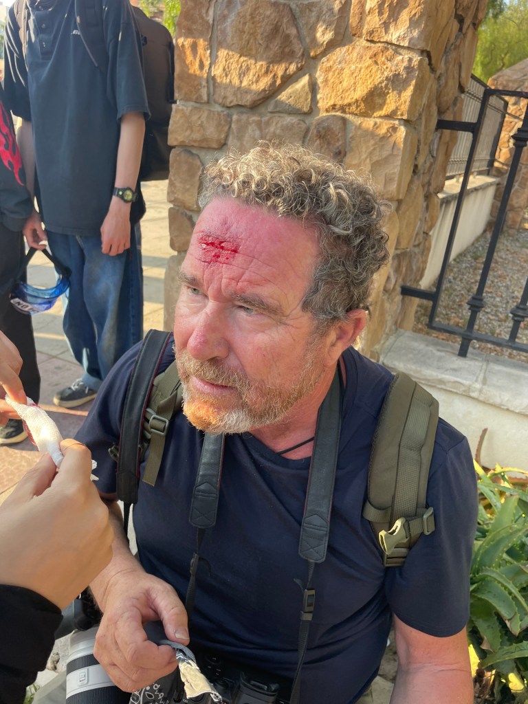 A photographer with a wound on his forehead.