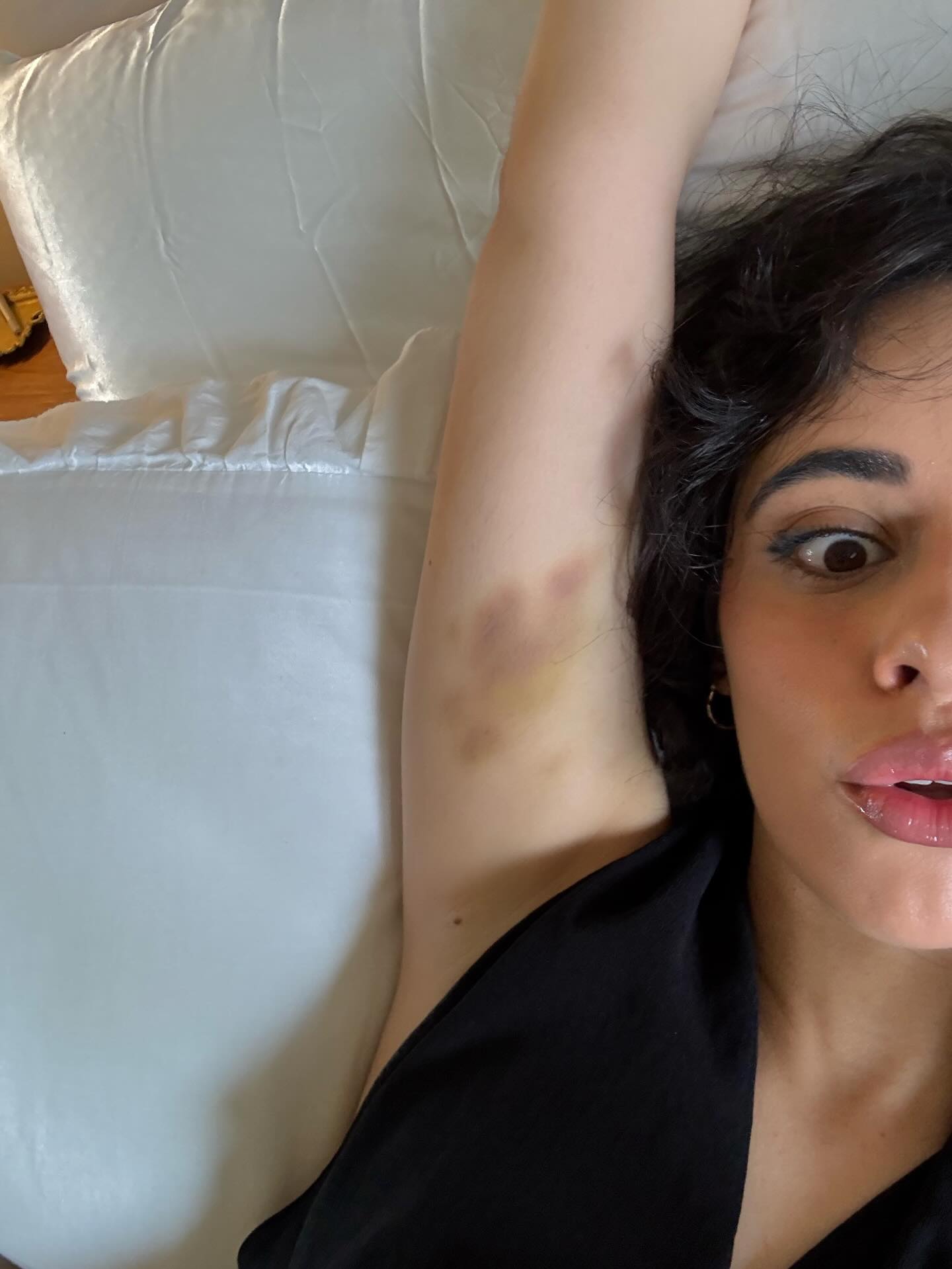 Camila Cabello shows off some battle wounds while rehearsing for her shows in Europe.