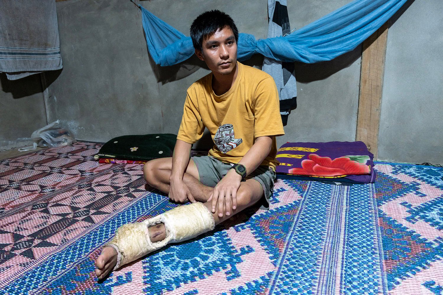 A man in a T-shirt sits on a patterned rug. One leg is in a cast with an opening that reveals a would.