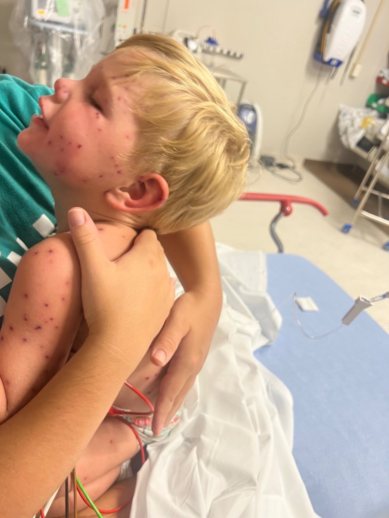 He bumped into a yellow jacket's nest while playing with his cousins.