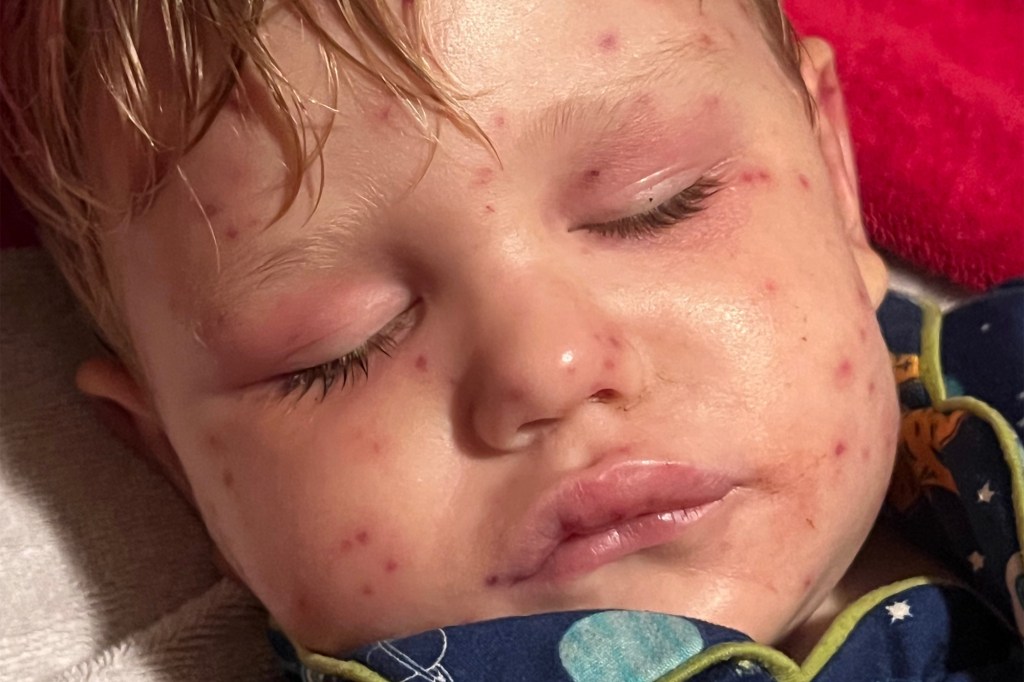 Beckham was stung more than 150 times.