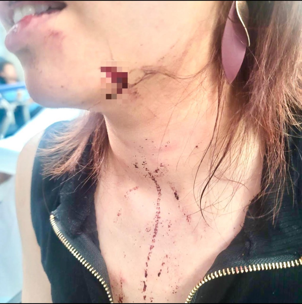 The assault left her bloodied. 