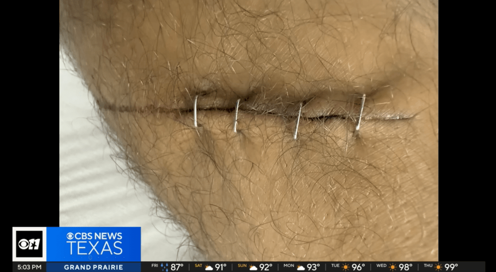 Slough suffered deep gashes in his legs from the strike.
