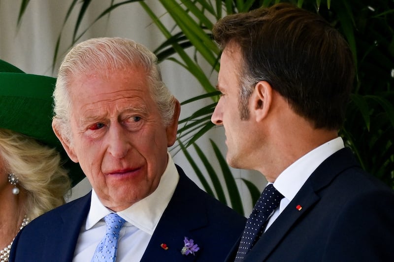 King Charles III with a bloodshot eye