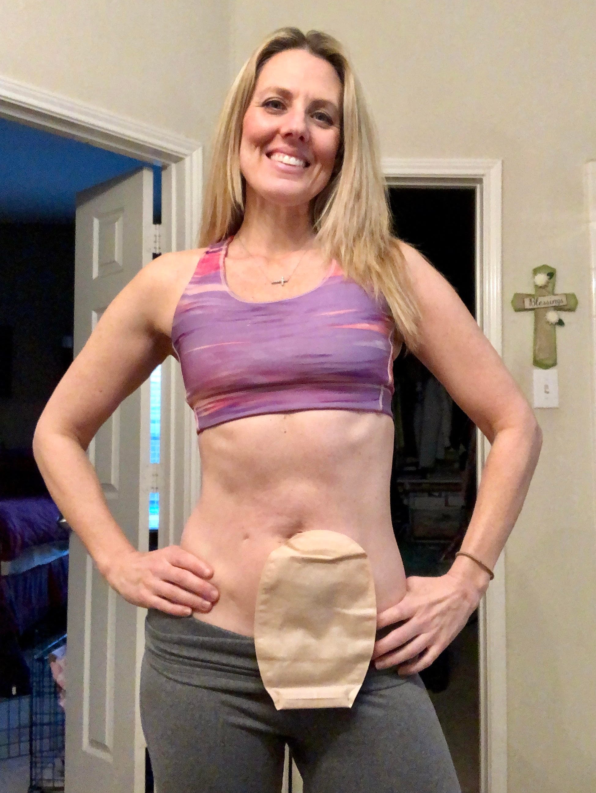 Tracy Robert in her home wearing a colostomy bag.