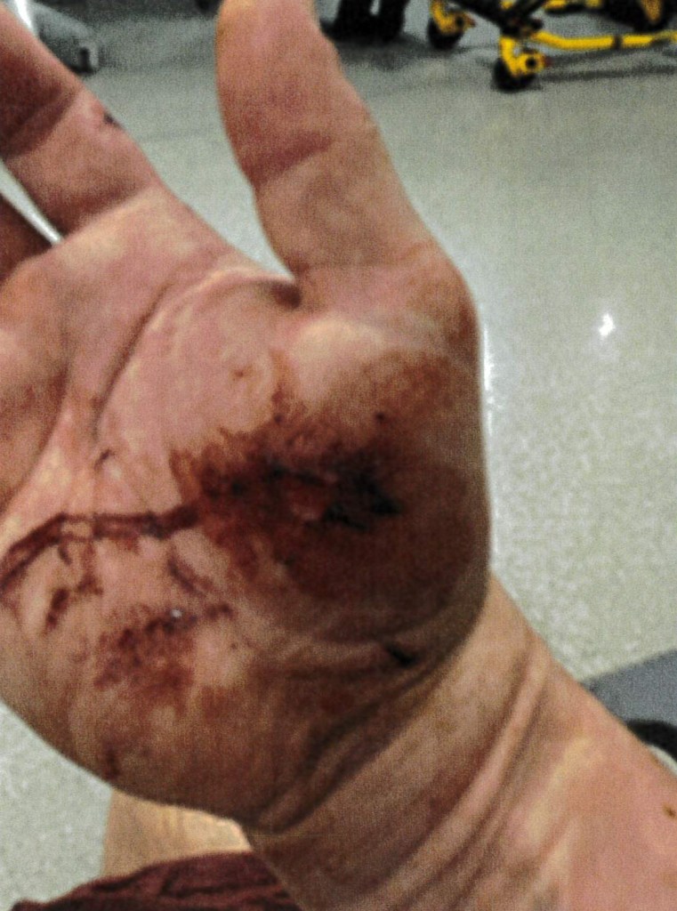 sanchez' injured hand with a big bloodyspot in the corner