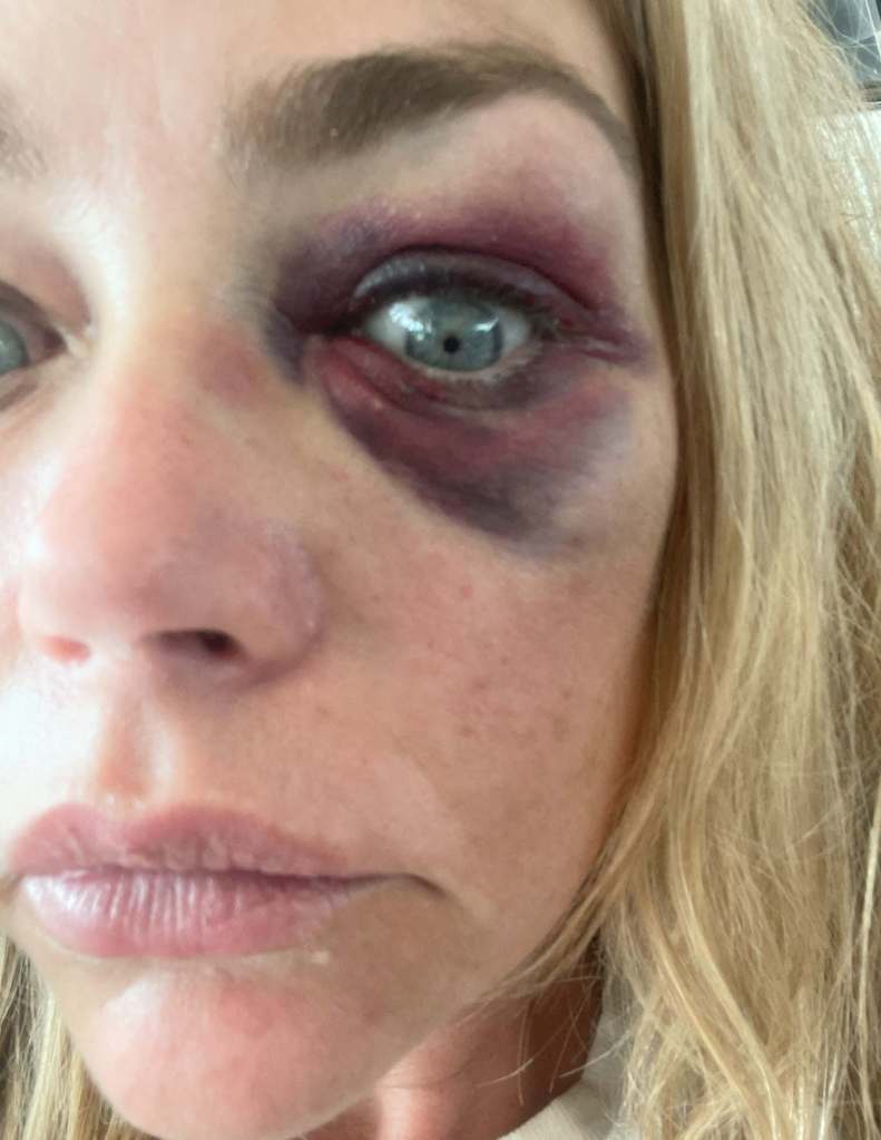 Denise Richards shares bruised photo of her face, which she alleges Aarpn Phypers gave her.