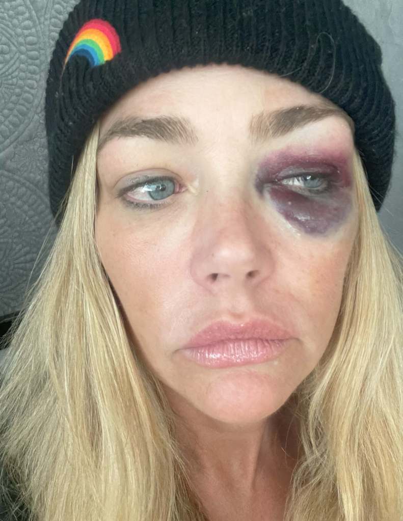 Denise Richards shares bruised photo of her face, which she alleges Aarpn Phypers gave her.