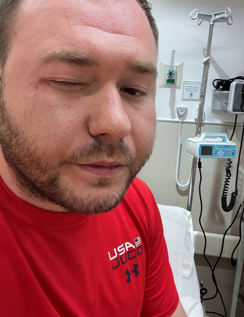 Arturas Lanchinskas seen here in a read shirt sitting in a hospital room with his right eye closed, suffered vision loss in his right eye after being splashed in the face with hot coffee on a JetBlue flight, he said in a lawsuit.