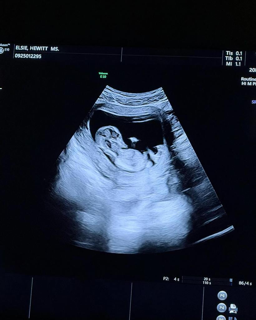 Pete Davidson is expecting first baby with pregnant girlfriend Elsie Hewitt