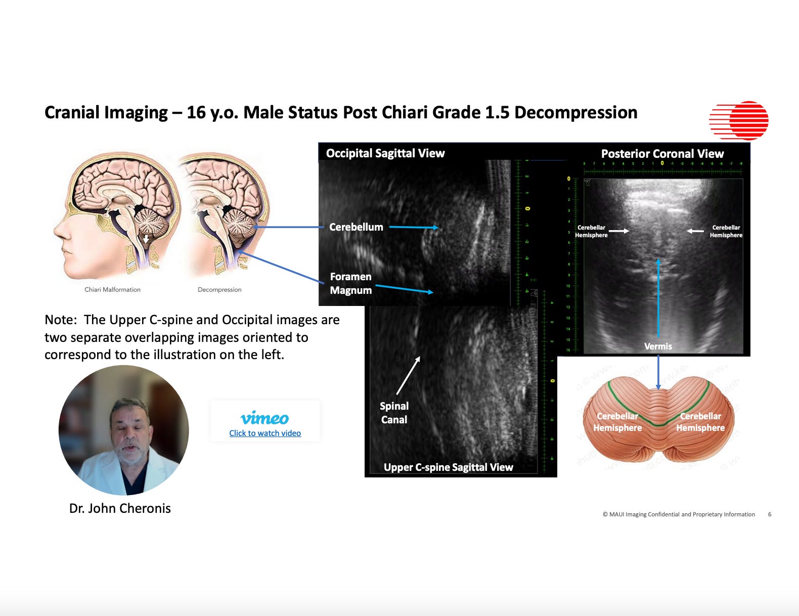 Cranial Imaging - 16 y.o. Male Status Post Chiari Grade 1.5 Decompression