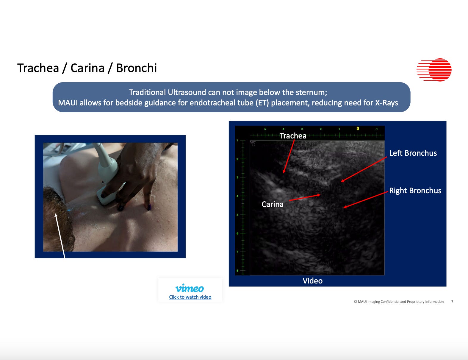 Traditional Ultrasound can not image below the sternum; MAUI allows for bedside guidance fore endotracheal tube (ET) placement, reducing need for X-Rays