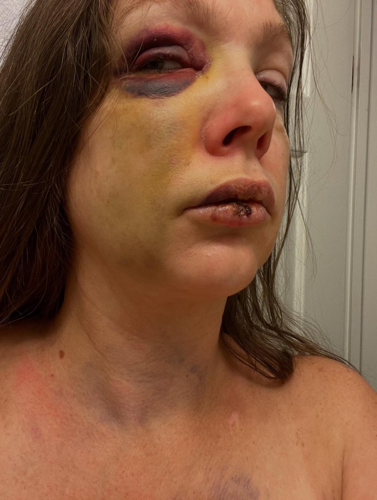 Close-up photo of a woman's face and neck showing severe bruising and injuries.