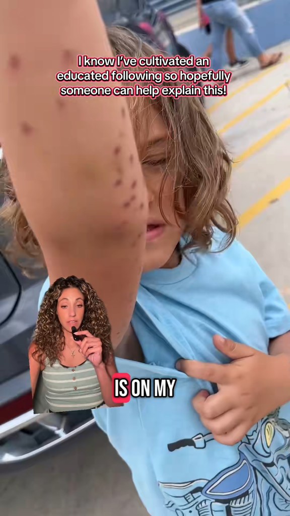 Boy with bite marks on his arm after an octopus attack.