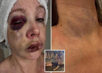 Gruesome photos show severely battered face of the woman knocked out during horrifying Cincinnati brawl