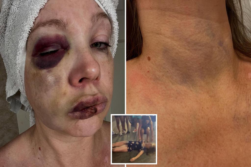 Gruesome photos show severely battered face of the woman knocked out during horrifying Cincinnati brawl