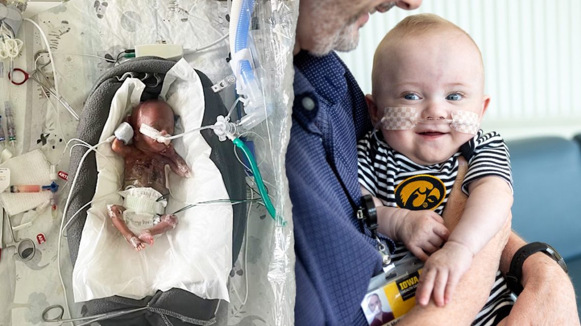 World’s most premature baby defies all medical odds to reach 1st birthday