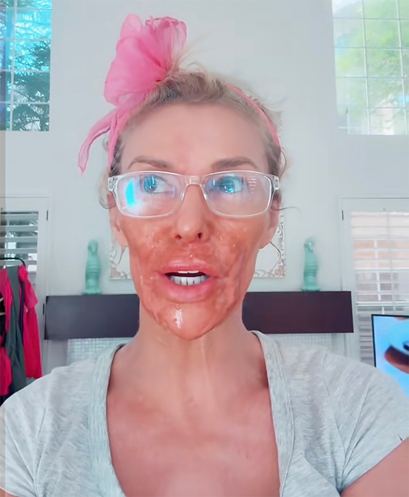 Brandi Glanville burnt from Nair