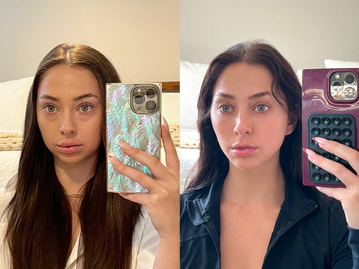 Composite of Emily Gordon taking selfies before (left) and after (right) her plastic surgeries