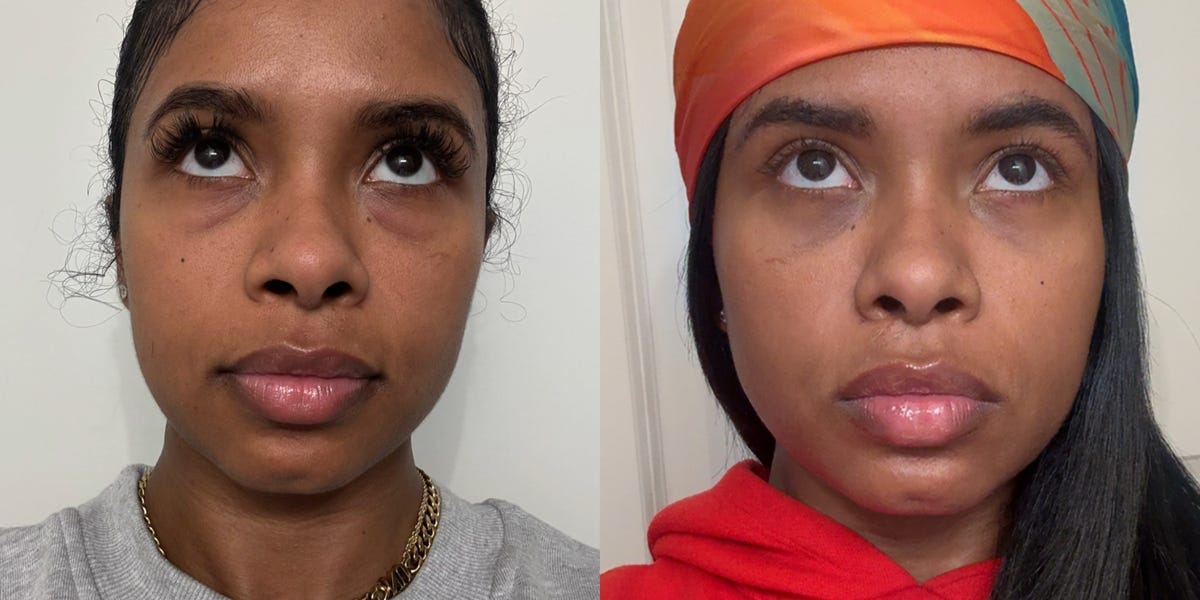 Composite of Sugelly Machado before and after her under eye bag surgery