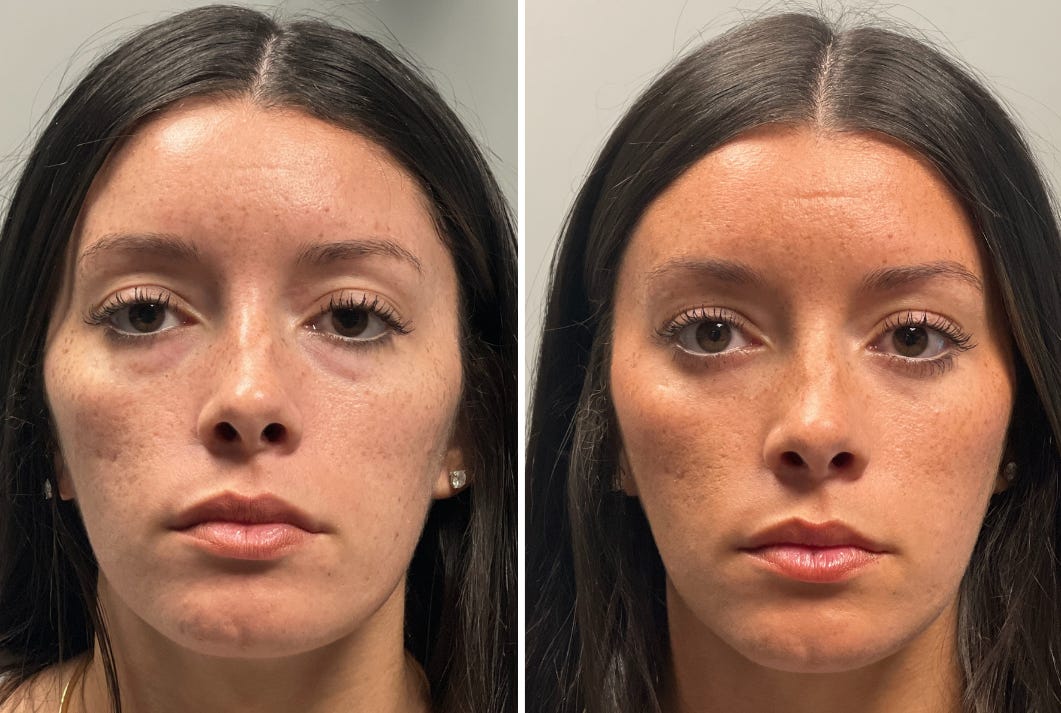 Composite of photo of Kiana Robinson with eye bags on left and photo of her post-removal on left