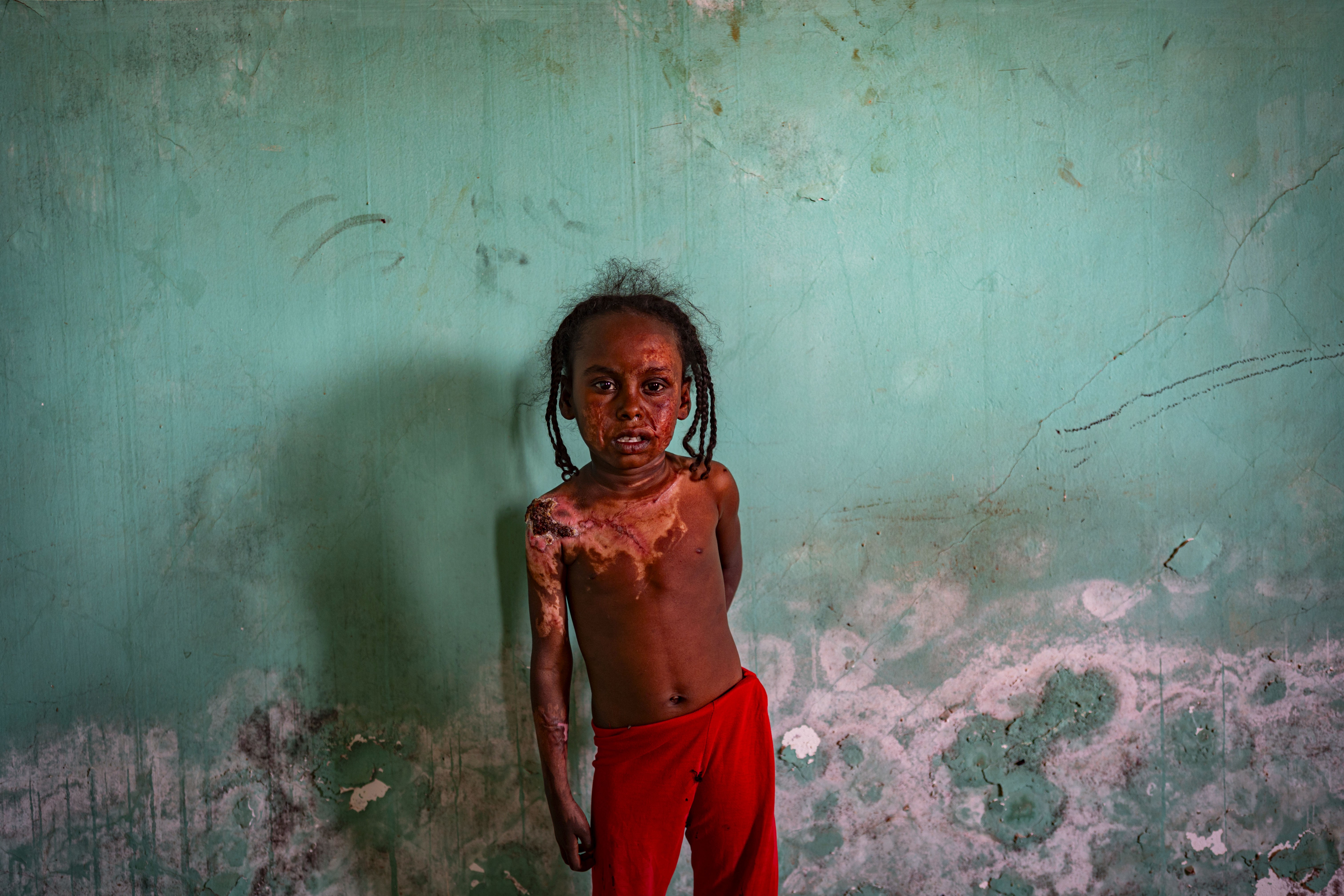 photo of young girl in braids wearing red pants facing camera, with mottled scars covering her face and bare chest, and a damaged turquoise blue wall behind