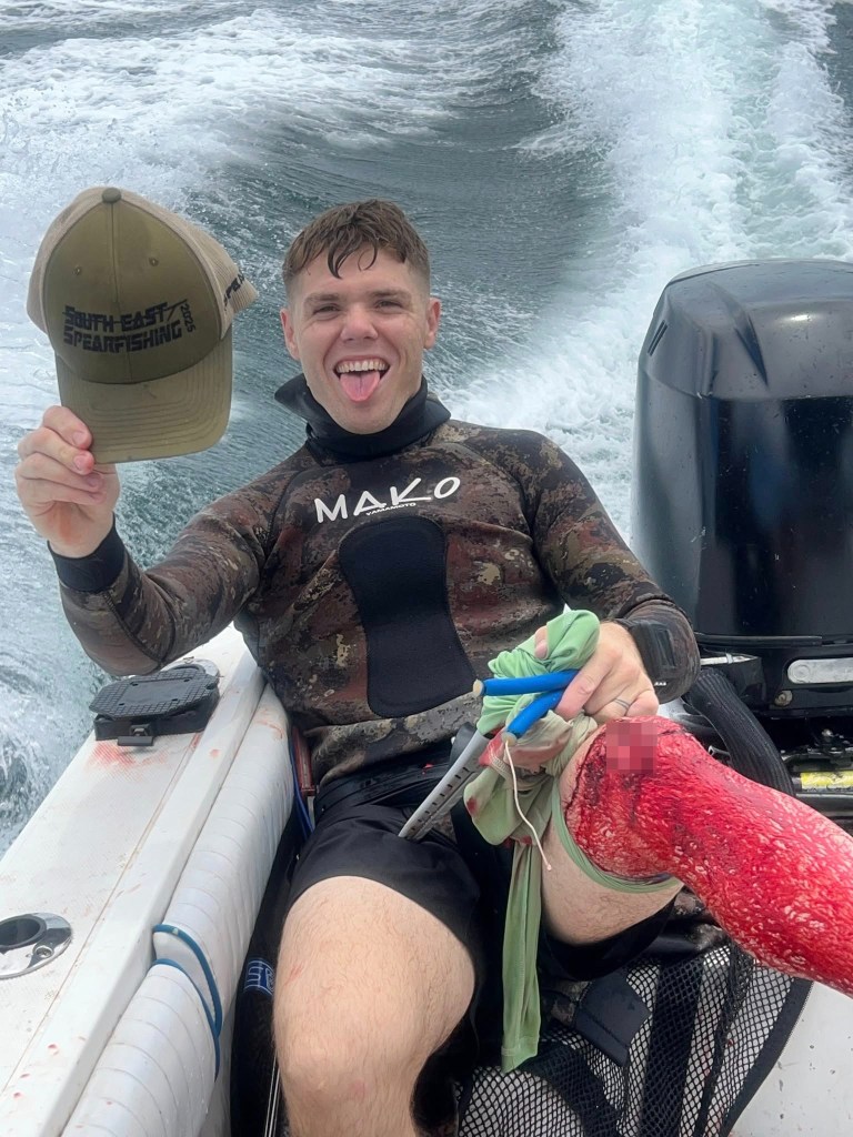 Chance Armand is seen after getting attacked by a shark while spearfishing on August 3, 2025.