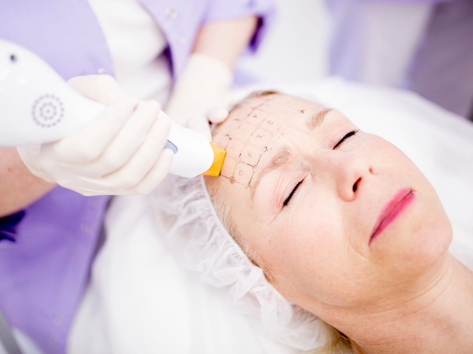 A woman getting radiofrequency treatment